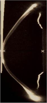 Keratoconus